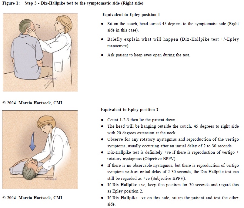 Bppv Epley Maneuver For Right Bppv Epley Maneuver For Right
